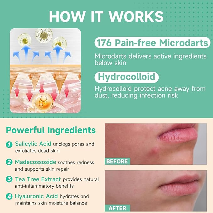 36-Count Microdart Acne Patches, Hydrocolloid Pimple Patches with Salicylic Acid & Madecossoside, Microdart Zit Patches for Deep Blemishes & Early Stage Acne (Patented)