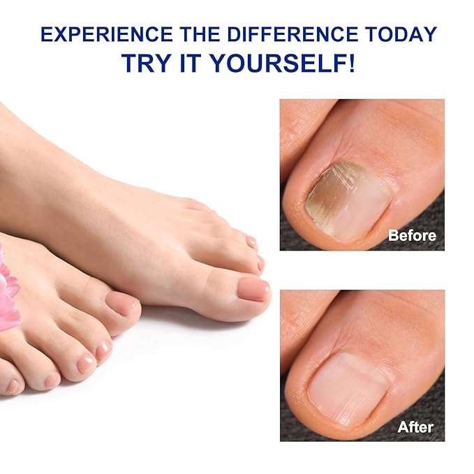 64 pcs Toenail Treatment Extra Strength-8-Hrs Overnight Nail Repair,ingrown toenail treatment,Strengthens Brittle Nails,Improves Texture & Thickening Hypoallergenic Easy