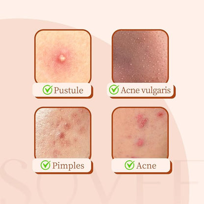 Pimple Patches for Face – 96 Count Hydrocolloid Acne Patch with Salicylic Acid, Tea Tree & Centella – Zit Patches for Blemishes, Breakouts & Spot Treatment