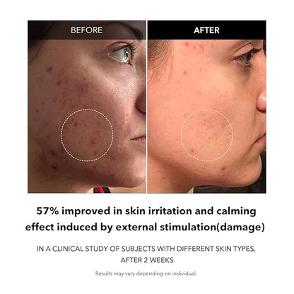 APRILSKIN Carrotene Clarifying Facial Serum | Vegan, Non-comedogenic | Blemish Clear, Dark Spot Corrector | Korea Skincare | Oily Skin, Sensitive Skin, Bumpy Skin | 1.25 fl.oz