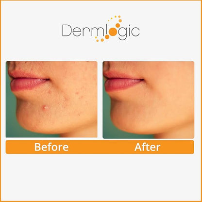 Acne Treatment Pads-Contains Glycolic, Lactic, Salicylic Acid. Eliminates Oily Skin, Clogged Pores & Cystic Breakouts. Removes Dark Spots, Whitehead & Blackhead Pimples for Face & Body.