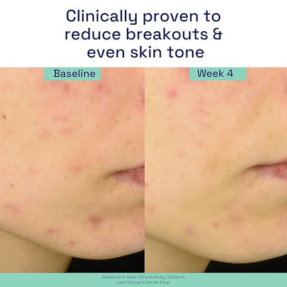 Cetaphil Gentle Clear Triple-Action Acne Treatment Serum with Salicylic Acid, Treats and Prevents Acne, Great for Post-Acne Marks, for All Skin Types, 1oz