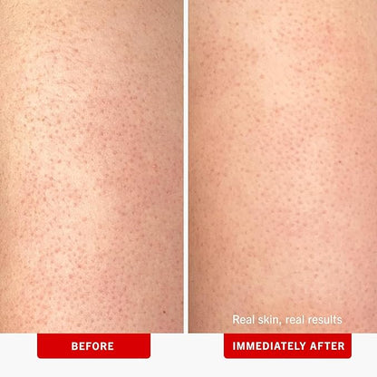 First Aid Beauty - KP Bump Eraser Body Scrub with 10% AHA, Keratosis Pilaris Exfoliator with Glycolic and Lactic acids, Helps Reduce Chicken Skin Bumps, Safe for Sensitive Skin, Strawberry Scent, 8 oz