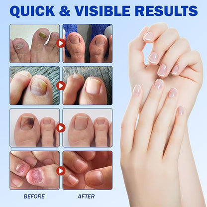Toenail Treatment Extra Strength 42pcs, Nail patches for Toenails, Overnight Toe Nail Treatments, Nighttime Nail Repair for Thick, Brittle and Discolored Toe Nail, Strengthen Damaged Foot Nails