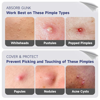 Cute Star Acne Patch with Salicylic Acid, Mix Shapes Hydrocolloid Pimple Stickers Iridescent Colors 72 Pcs, Fashion Zits Blemishes Breakouts Patches