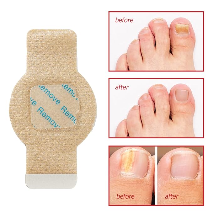 Keravix Nail Patches for Toenails & Fingernails – 63Pcs Parches para uñas con hongos, 8-Hour Fungus Nail Care Repair Stickers for Damaged Nails, for Extra Strengthening, Safe for Sensitive Skin