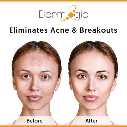 Acne Treatment Pads-Contains Glycolic, Lactic, Salicylic Acid. Eliminates Oily Skin, Clogged Pores & Cystic Breakouts. Removes Dark Spots, Whitehead & Blackhead Pimples for Face & Body.