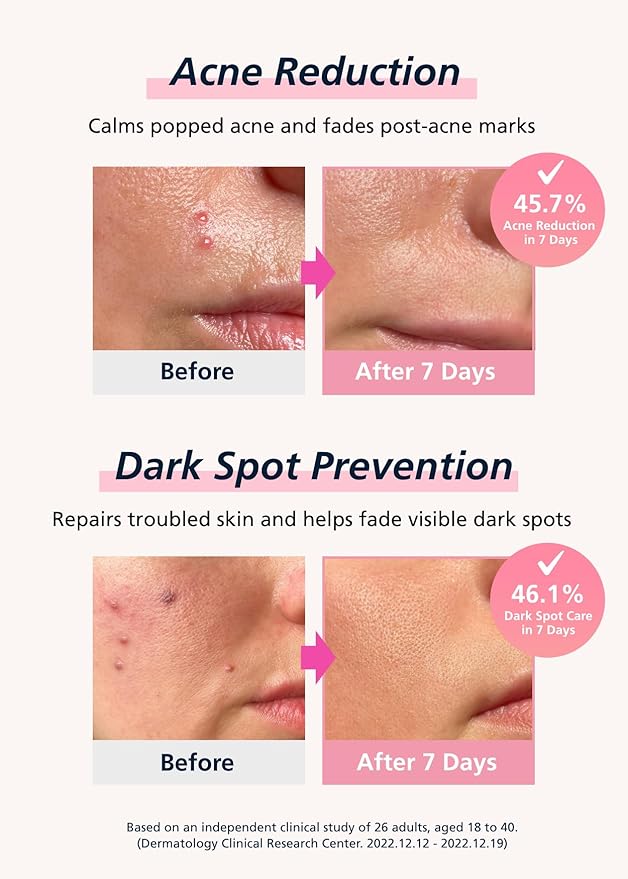 Easyderm Real Calming Patch Pimple Patches, Niacinamide, Hyaluronic Acid, EGF, K-Beauty Skincare | 6 Patches per Pack, 4 Packs (24 Total) Micro Point length : 285μm