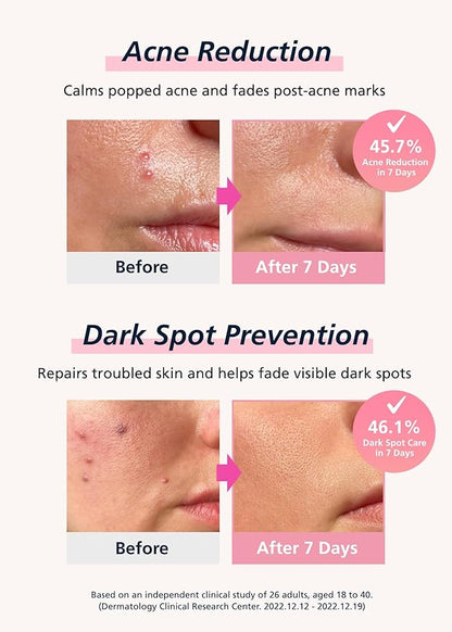 Easyderm Real Calming Patch Pimple Patches, Niacinamide, Hyaluronic Acid, EGF, K-Beauty Skincare | 6 Patches per Pack, 4 Packs (24 Total) Micro Point length : 285μm