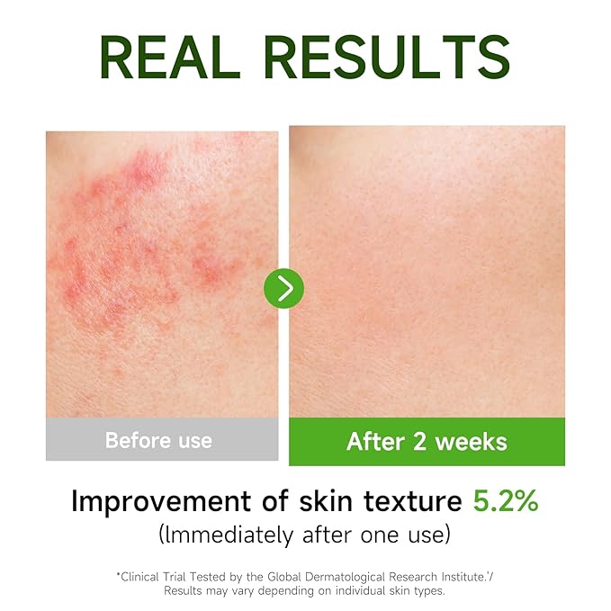 Centella Asiatica Serum Centella Tea Tree Ampoule Facial Serum Korean Centella Serum for Acne-Prone Oil Skin Soothing, Calming, Reduce Redness 105ml