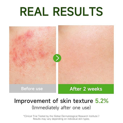 Centella Asiatica Serum Centella Tea Tree Ampoule Facial Serum Korean Centella Serum for Acne-Prone Oil Skin Soothing, Calming, Reduce Redness 105ml