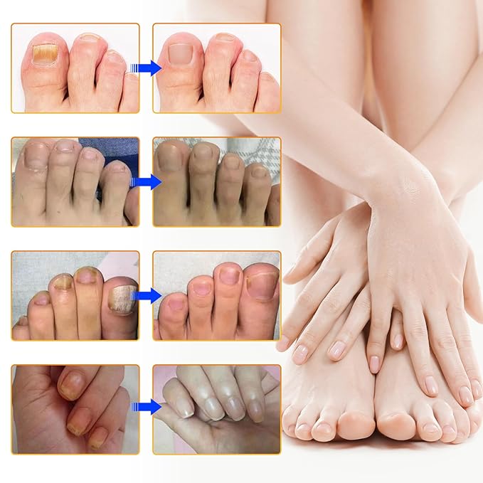 64 pcs Toenail Treatment Extra Strength-8-Hrs Overnight Nail Repair,ingrown toenail treatment,Strengthens Brittle Nails,Improves Texture & Thickening Hypoallergenic Easy