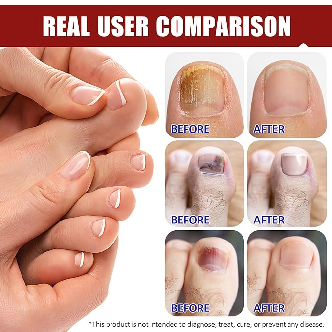 Toenail Treatment Extra Strength, 32 Pcs Nail Patches Overnight Nail Fast Acting Care for Damaged Nails- Visible Results in 8 Hours-Renewal for Men and Women