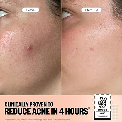 PEACE OUT Acne Healing Dots Helps Clear Blemishes Overnight, Fast Acting Hydrocolloid Pimple Patches for Breakouts with Salicylic Acid, Retinol and Aloe Vera, Award Winning Skincare Solution 60 Count