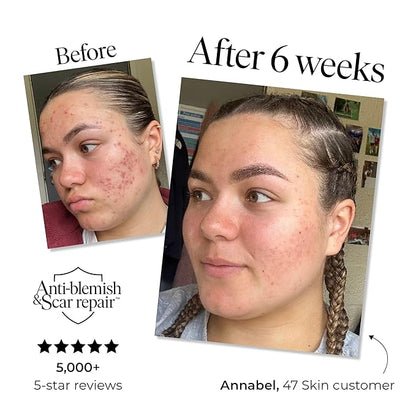 Hydrating Face Serum for Clearing Acne and Scars, Anti-Blemish & Scar Repair Serum Skincare Treatment with Silver Chitoderm Smooth Skin Moisturiser Serum for All Skin Types (1.69 oz)