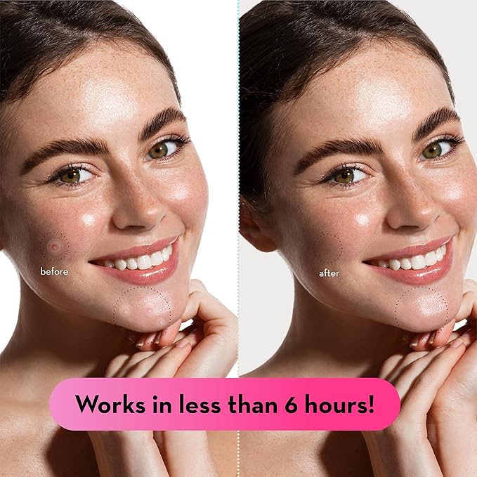 grace & stella Pimple Patches for Face (66 Dots) - Hydrocolloid Acne Patches for Face - Invisible Zit Stickers - Flatten Spots in 6-8 Hrs